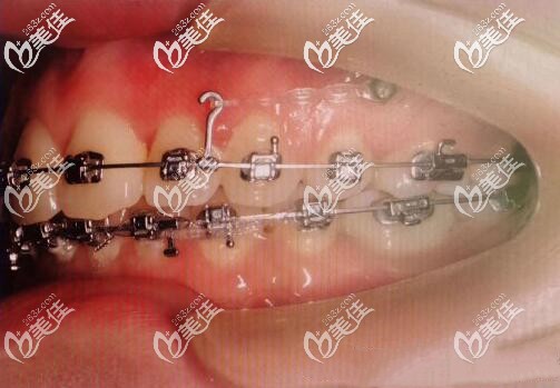 戴進口金屬自鎖托槽矯正齙牙