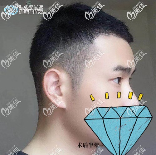 M型兩額角脫發(fā)長不出來了不用怕!通過頭發(fā)種植補(bǔ)額角即可填補(bǔ)空白