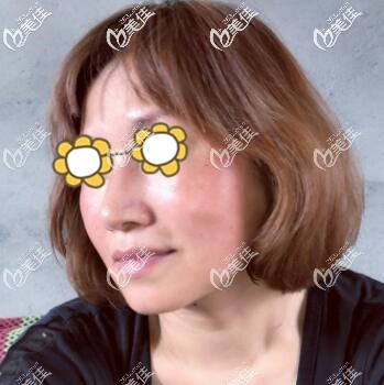 熱瑪吉術(shù)后2天照