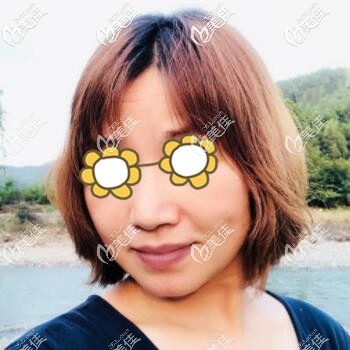 做熱瑪吉術(shù)后5天效果圖