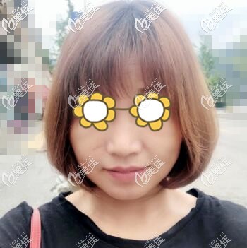 親身體驗熱瑪吉術(shù)后13天效果照