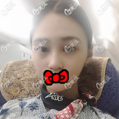 脂肪豐面部術(shù)后半個(gè)月效果展示