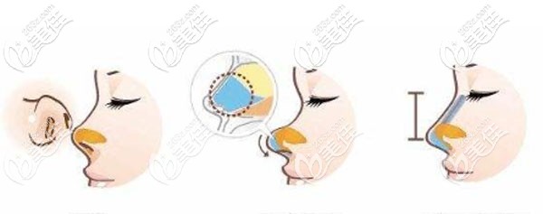 密斯燕尾型鼻綜合技術(shù)優(yōu)勢(shì) 密斯燕尾型鼻綜合技術(shù)優(yōu)勢(shì)