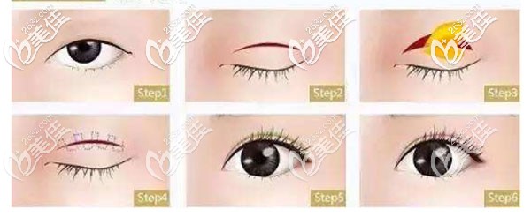 密斯黃金美眼組合技術(shù)優(yōu)勢(shì) 密斯黃金美眼組合技術(shù)優(yōu)勢(shì)