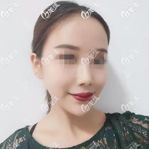 以我注射玻尿酸墊下巴的真實(shí)經(jīng)歷來(lái)看選擇喬雅登好還是絲麗好