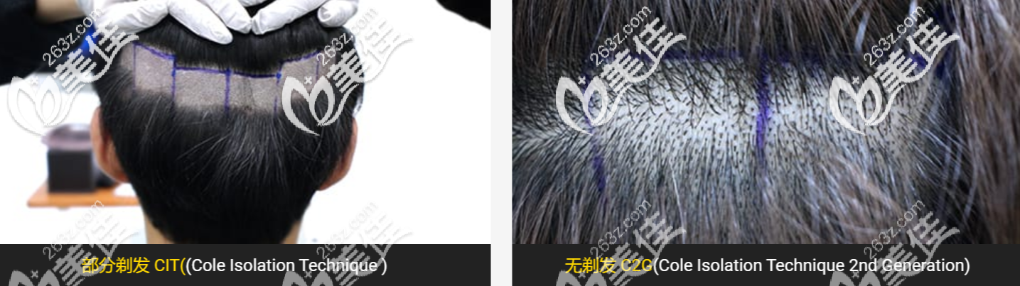 部分剃發(fā)與無剃發(fā)對比