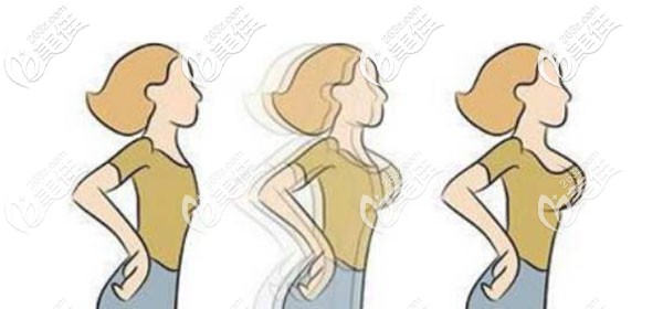 南寧密斯整形方觀瑞做三維豐胸效果好不好