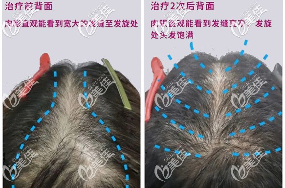 電波密發(fā)治療2次效果對比圖 電波密發(fā)治療2次效果對比圖