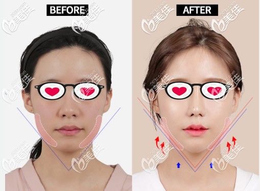 韓國ID醫(yī)院削下頜骨案例 韓國ID醫(yī)院削下頜骨案例