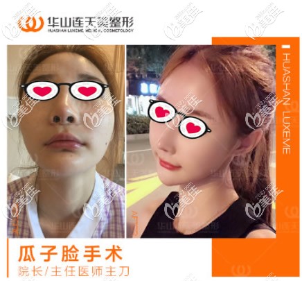 高俊明V-line瓜子臉整形前后對比照片