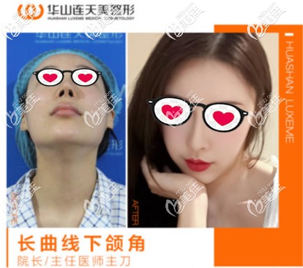 杭州華山連天高俊明長曲線下頜角截骨案例