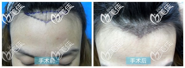 成都絲恒美人尖種植案例效果