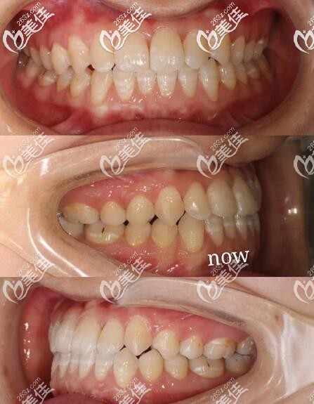 南京鼓樓美奧口腔隱適美隱形矯正反頜案例