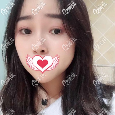 滿臉雀斑的敏感肌做皮秒激光祛斑90天變化過程圖，你要不要看？