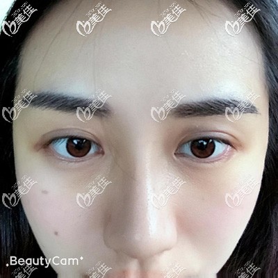眉毛種植7天恢復(fù)效果 眉毛種植7天恢復(fù)效果