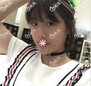 術(shù)前我的單眼皮 術(shù)前我的單眼皮