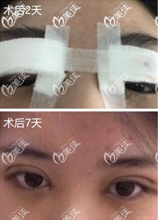 剛手術(shù)完樣子 剛手術(shù)完樣子