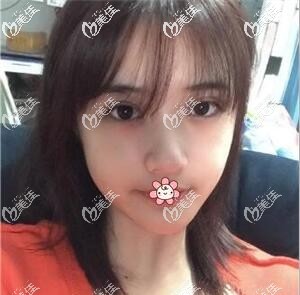 我在重慶軍科整形割完雙眼皮半個月了 我在重慶軍科整形割完雙眼皮半個月了