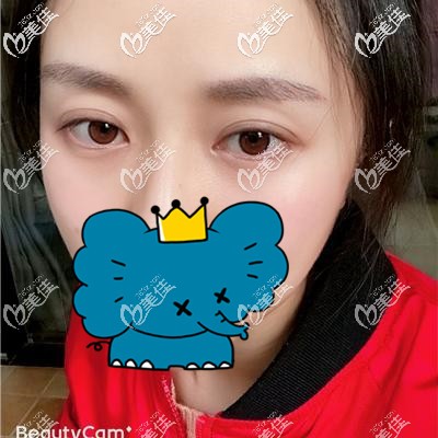 眉毛種植一個月進入脫落期 眉毛種植一個月進入脫落期