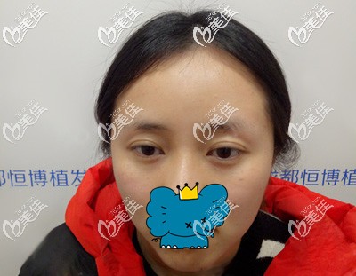 眉毛種植術(shù)前照片 眉毛種植術(shù)前照片