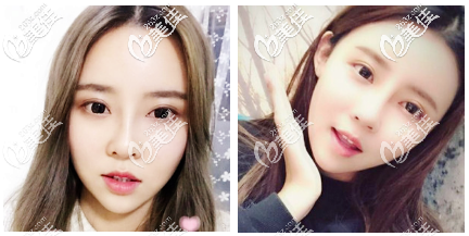 不知道韓國面吸哪家醫(yī)院好?請參考我在韓國明星線做的面吸效果吧