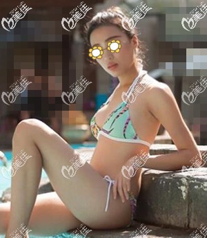 距離我做威寧之星假體隆胸已經(jīng)3個多月了，跟大家分享一下術(shù)后的感受如何吧！