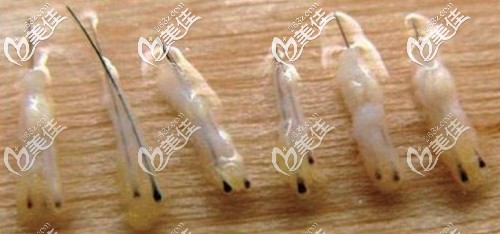 植發(fā)手術中提取的毛囊組織 植發(fā)手術中提取的毛囊組織