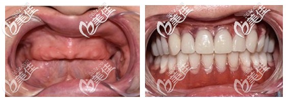老爸種植全口牙前后效果對比照片 老爸種植全口牙前后效果對比照片