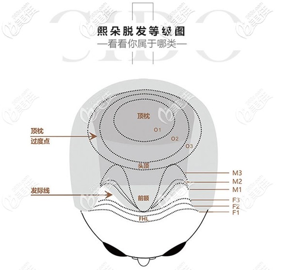 熙朵不同類型的脫發(fā)等級圖