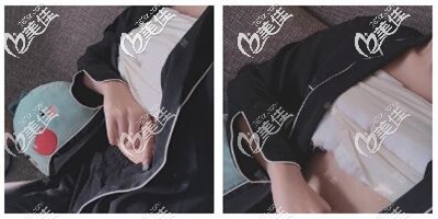 假體隆胸手術(shù)后第四天