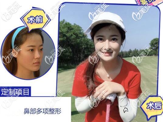 羅志敏隆鼻案例 羅志敏隆鼻案例