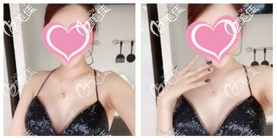 假體隆胸術(shù)后拆線