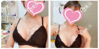 假體隆胸手術(shù)后一個(gè)月恢復(fù)效果