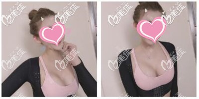 奉上平胸做了假體300cc隆胸手后效果圖，也不算大的很夸張