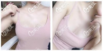 假體隆胸手術(shù)恢復(fù)半年效果