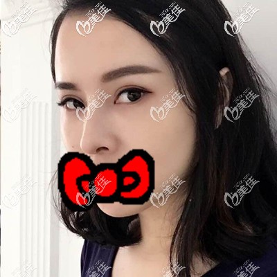 填淚溝術(shù)后1個月照片