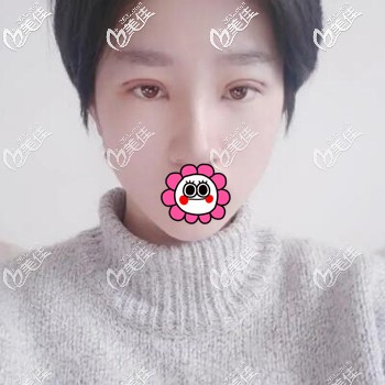 做雙眼皮術(shù)后5天時的恢復(fù)效果照 做雙眼皮術(shù)后5天時的恢復(fù)效果照