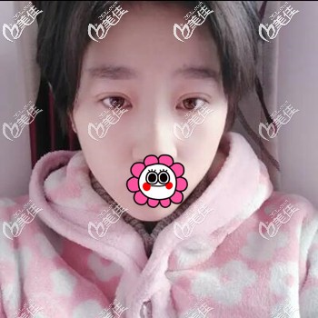 在大連做雙眼皮術(shù)后25天恢復(fù)照 在大連做雙眼皮術(shù)后25天恢復(fù)照