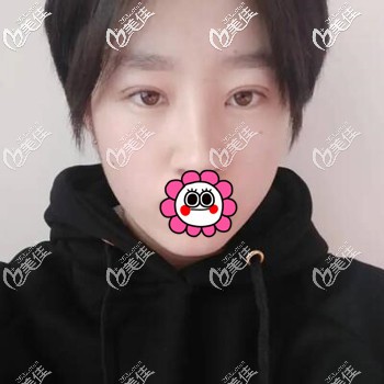 今天就把我親身體驗貝塞爾雙眼皮的恢復過程及術(shù)后效果跟大家分享一下！