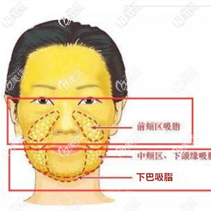 雙下巴和下頜緣的區(qū)域分布圖 雙下巴和下頜緣的區(qū)域分布圖