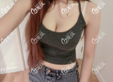 西安高一生自體脂肪隆胸術(shù)后兩個月的樣子 西安高一生自體脂肪隆胸術(shù)后兩個月的樣子