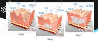 注射玻尿酸除皺的原理 注射玻尿酸除皺的原理