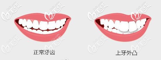 門牙外凸建議做矯正來改善 門牙外凸建議做矯正來改善