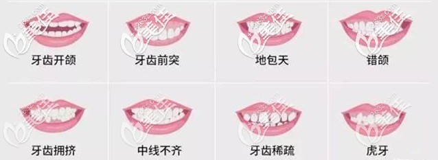 牙齒出現(xiàn)這些情況就要考慮矯正啦 牙齒出現(xiàn)這些情況就要考慮矯正啦