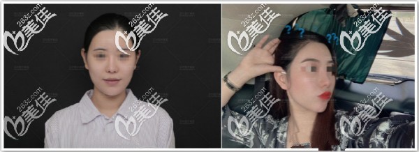 北京沃爾劉彥軍鼻修復(fù)真實(shí)案例 北京沃爾劉彥軍鼻修復(fù)真實(shí)案例