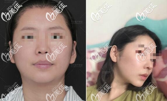 劉彥軍醫(yī)生隆鼻案例 劉彥軍醫(yī)生隆鼻案例