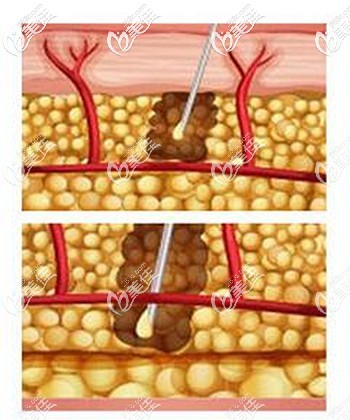泉州歐菲自體脂肪豐胸的優(yōu)勢 泉州歐菲自體脂肪豐胸的優(yōu)勢