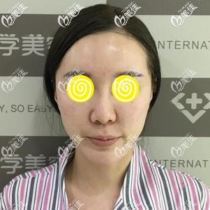 做鼻綜合手術前難看的鼻形 做鼻綜合手術前難看的鼻形