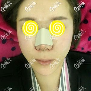 找阪田和明醫(yī)生做鼻綜合術后效果明顯 找阪田和明醫(yī)生做鼻綜合術后效果明顯