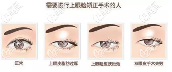 哪些人需要做上瞼下垂矯正